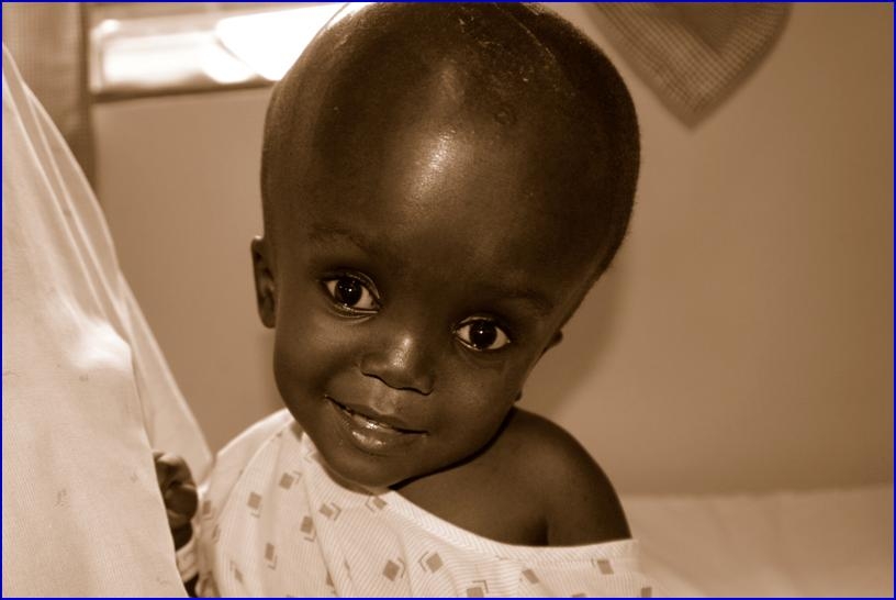 hydrocephalus in children