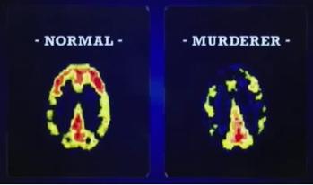 sociopathy brain differences