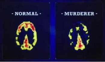 MRI normal vs murderer
