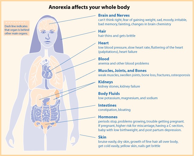 This photo depicts how anorexia affects the body (in a woman). It causes a ton of problems. https://www.womenshealth.gov/publications/our-publications/fact-sheet/anorexia-nervosa.html