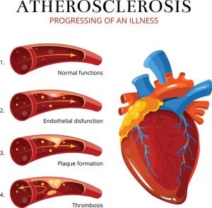 Source:https://www.belmarrahealth.com/atherosclerosis-prevention-natural-home-remedies-diet-exercise/   This is what Atherosclerosis looks like.